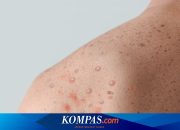 Ancaman Mpox, Bagaimana Pencegahannya?