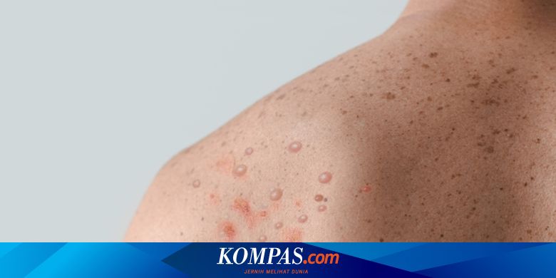 Ancaman Mpox, Bagaimana Pencegahannya?