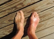 Navigating Nutrition: The Role of Diet in Managing Gout