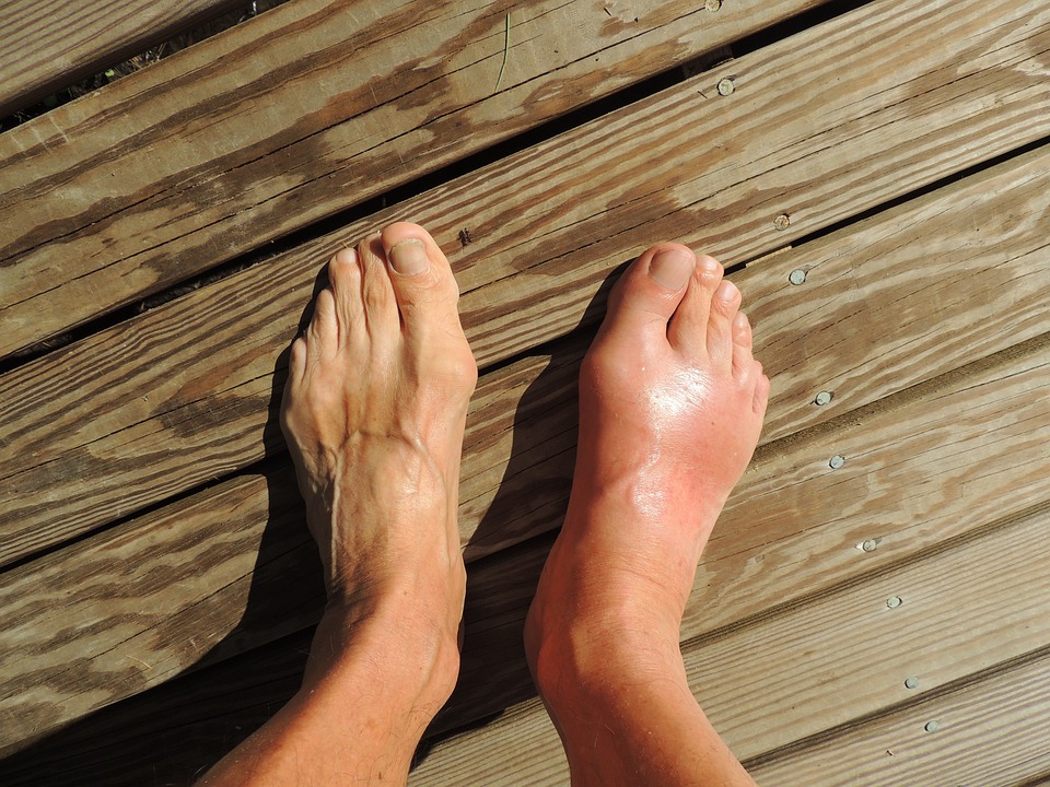 Navigating Nutrition: The Role of Diet in Managing Gout