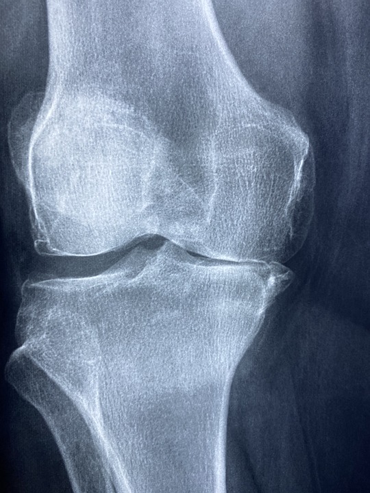 The Impact of Diet on Inflammation in Rheumatoid Arthritis Patients